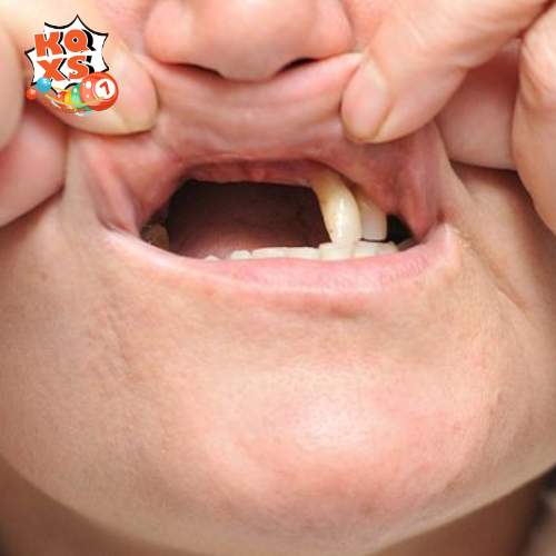 Chiêm bao thấy rụng răng hàm trên